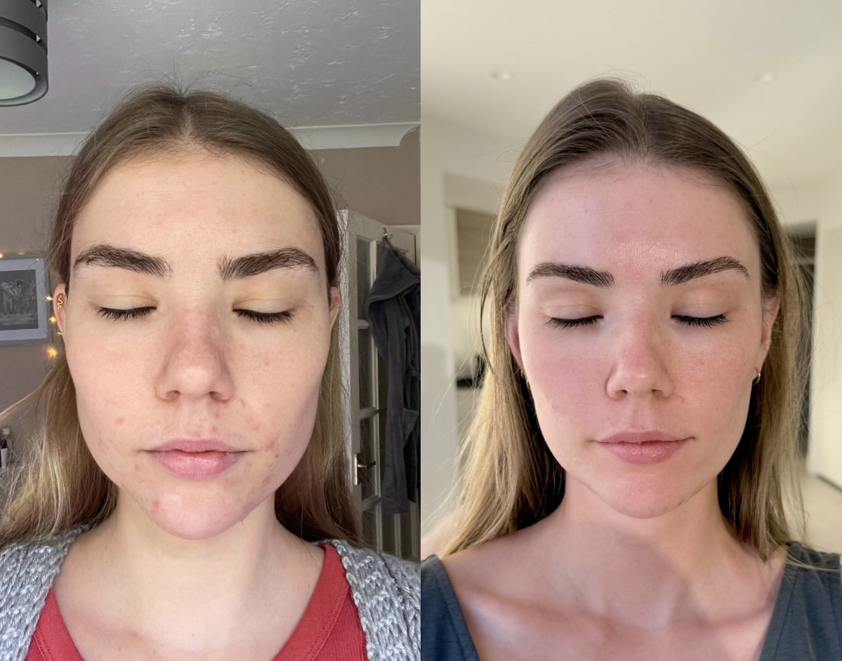 Side-by-side comparison of a woman's face before and after a treatment or change, with a neutral background after using Perception Skin products